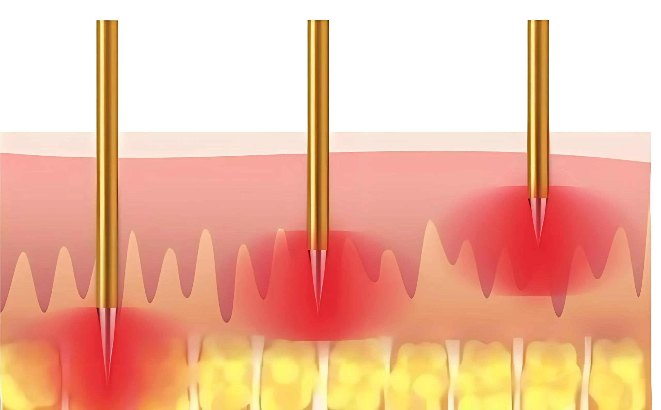how microneedling stimulate the collagen production