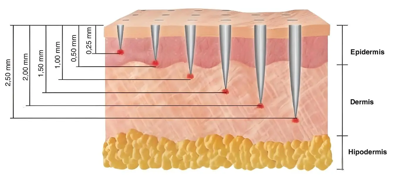 micro needles size for difference skin layers
