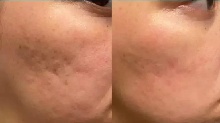 How Long To Get Results From Microneedling