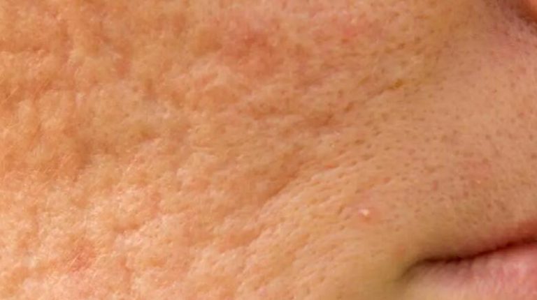 acne scar treatment by microneedling derma roller