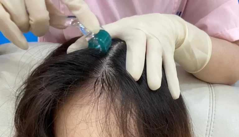 microneedling works for hair growth